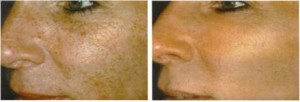 fotofacial1-461x157