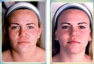 microdermabrasionacne