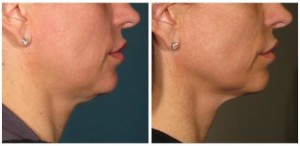 ultherapy_chin_crop-461x225