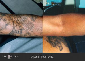 Tattoo Removal | Dermatology and Laser Centre of Los Angeles