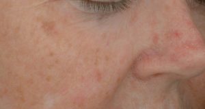 Before PDT treatments