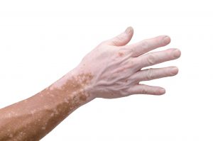 Vitiligo