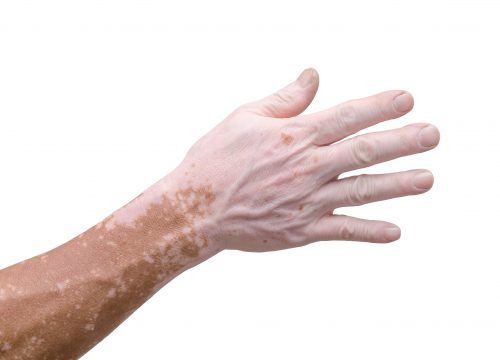 Vitiligo