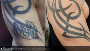 before and after PicoSure tattoo removal photos