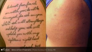 before and after PicoSure tattoo removal photos