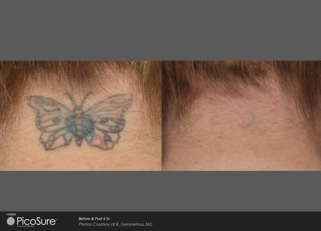 before and after PicoSure tattoo removal photos