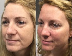 Before and after Restylane Lyft treatments