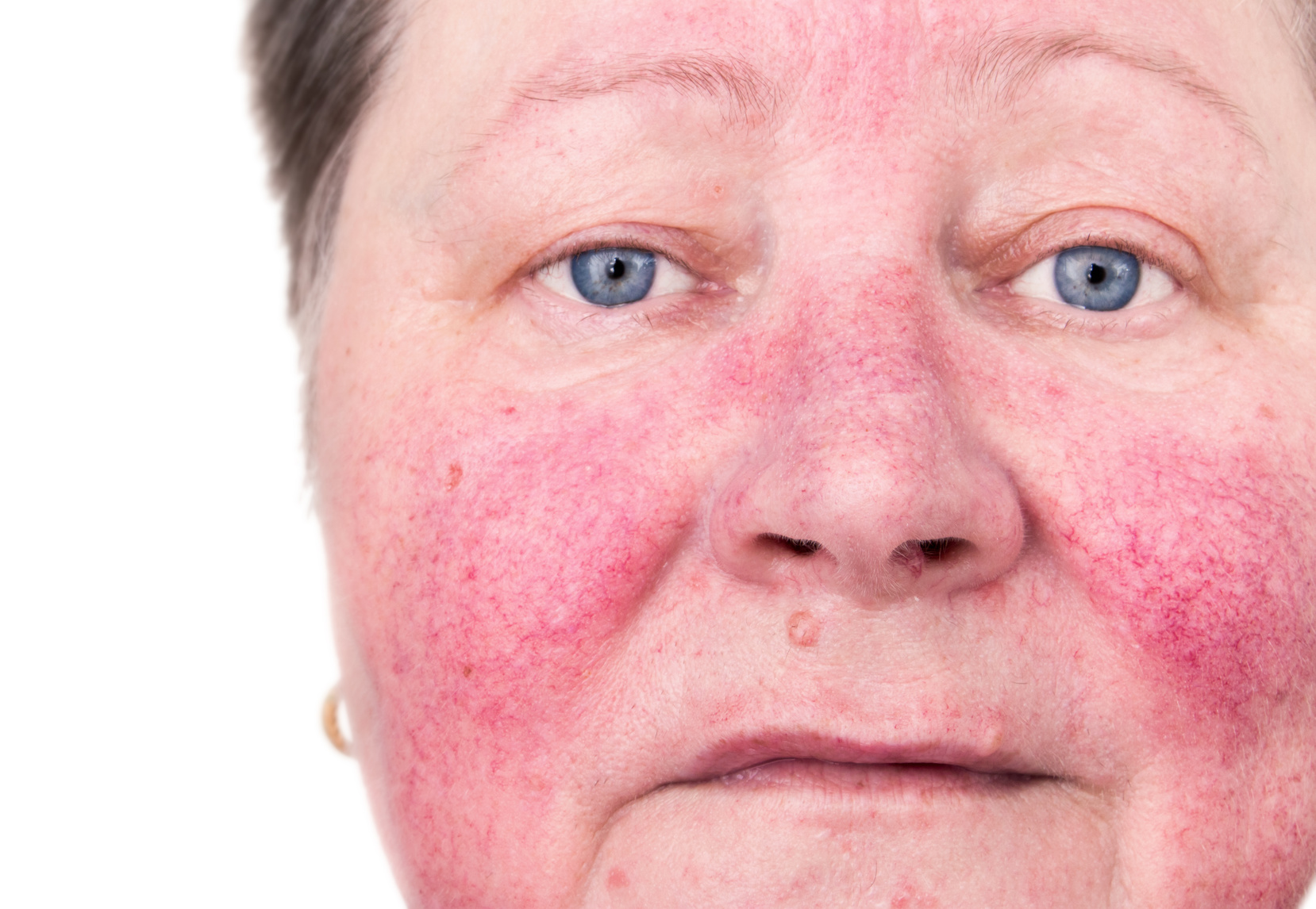 Skin Redness Poikiloderma And Rosacea Dermatology And Laser Centre