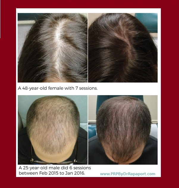 Before and after hair restoration photos