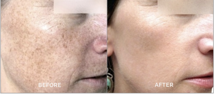 Before and after IPL photofacial results