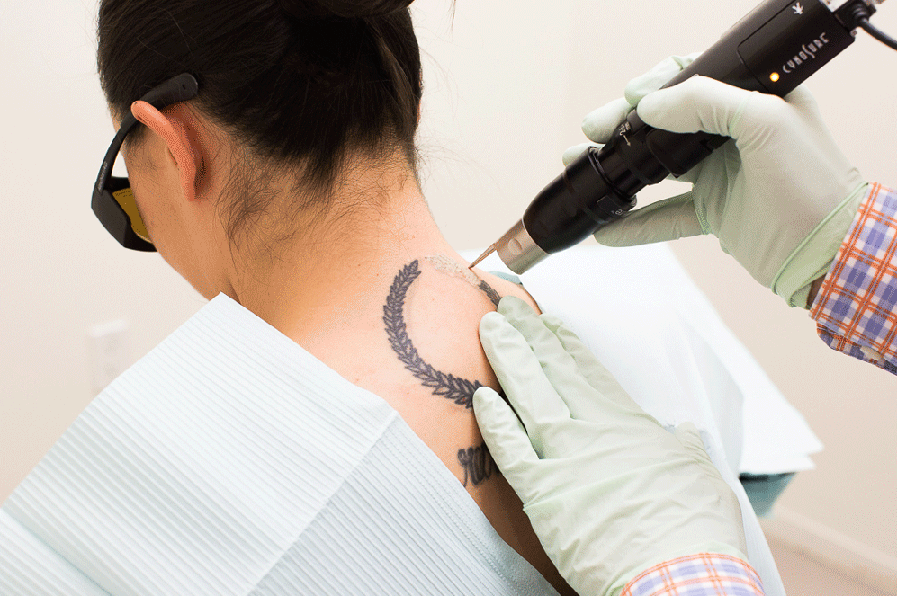 Tattoo Removal | Dermatology and Laser Centre of Los Angeles