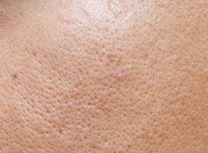 Enlarged Pores - Causes, Home Remedies and Treatments