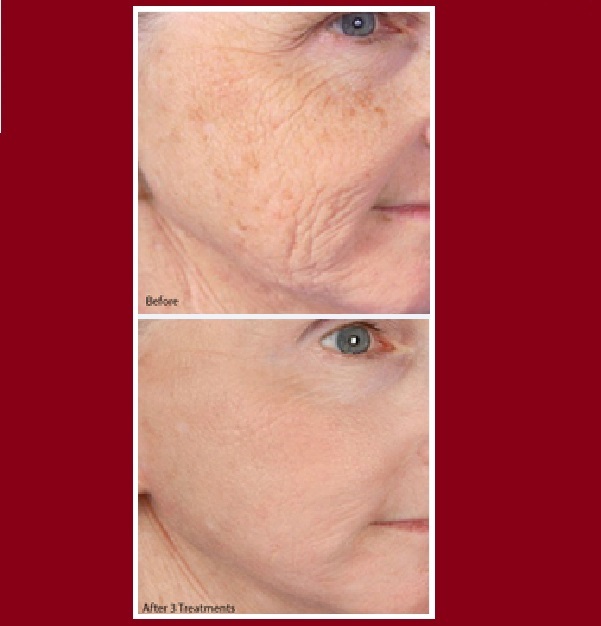 Rejuvenation before and after photos