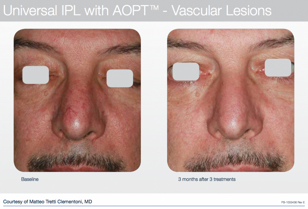 Before and after photofacial results