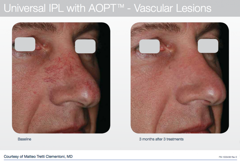Before and after photofacial results