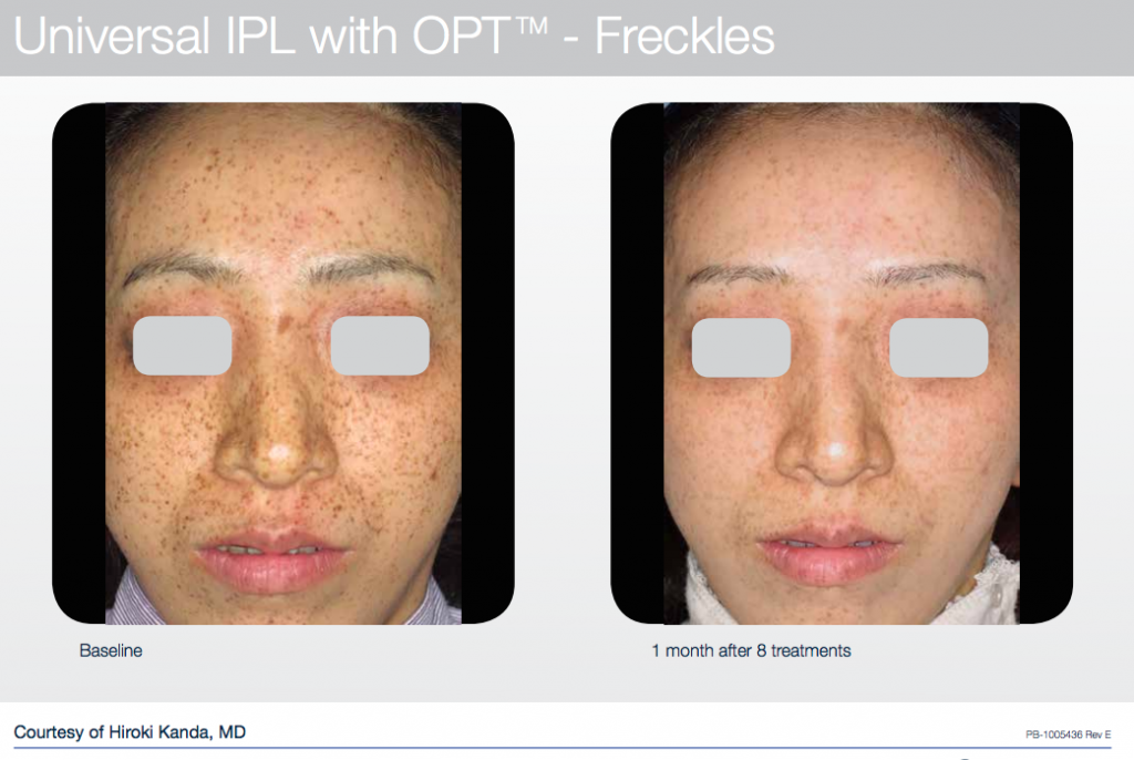 Before and after photofacial results