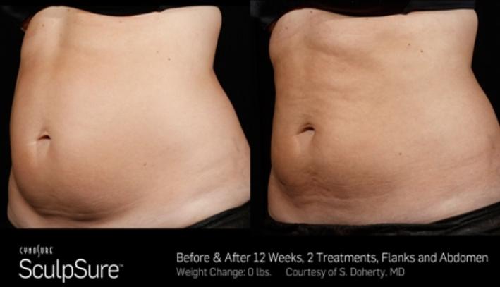 Before and after SculpSure photos