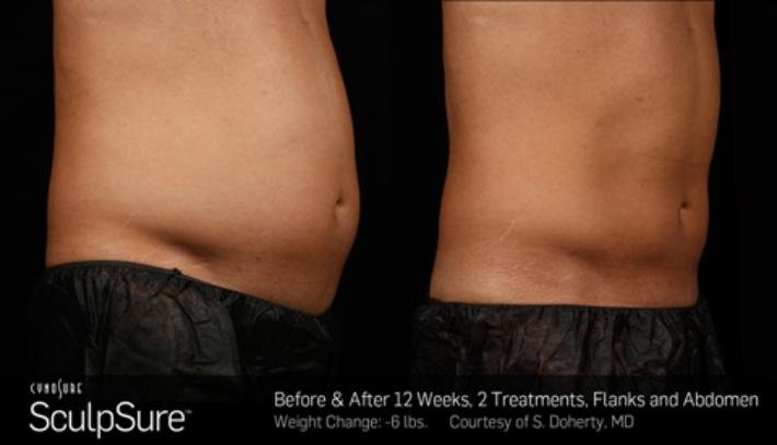 Before and after SculpSure photos