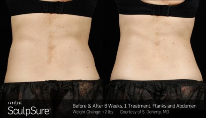 Before and after SculpSure photos