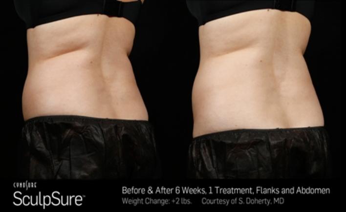 Before and after SculpSure photos