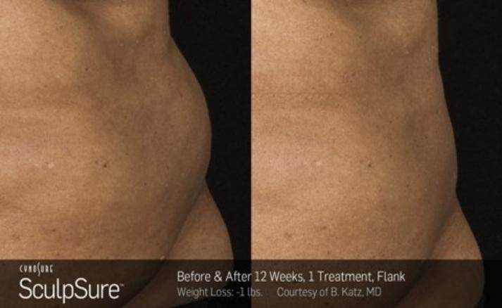 Before and after SculpSure photos