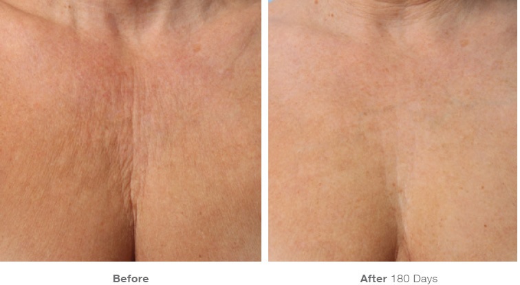 Before and after Ultherapy treatments