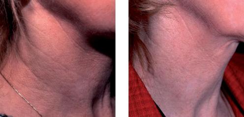 Before and after neck treatments