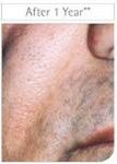 After Restylane treatments