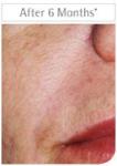 After Restylane treatments