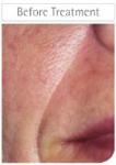 Before Restylane treatments
