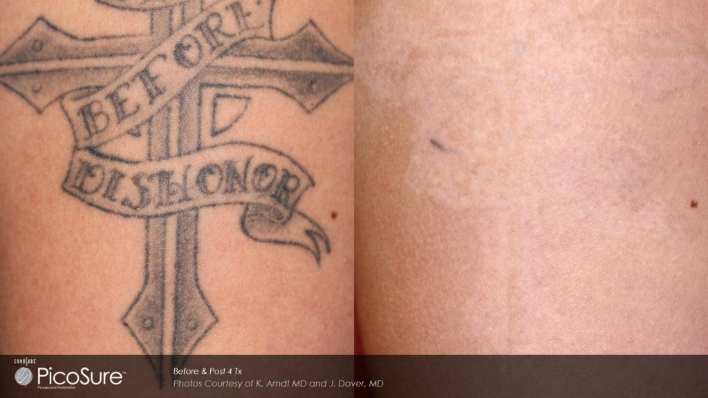 before and after PicoSure tattoo removal photos