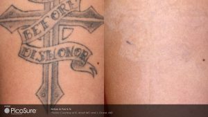 before and after PicoSure tattoo removal photos