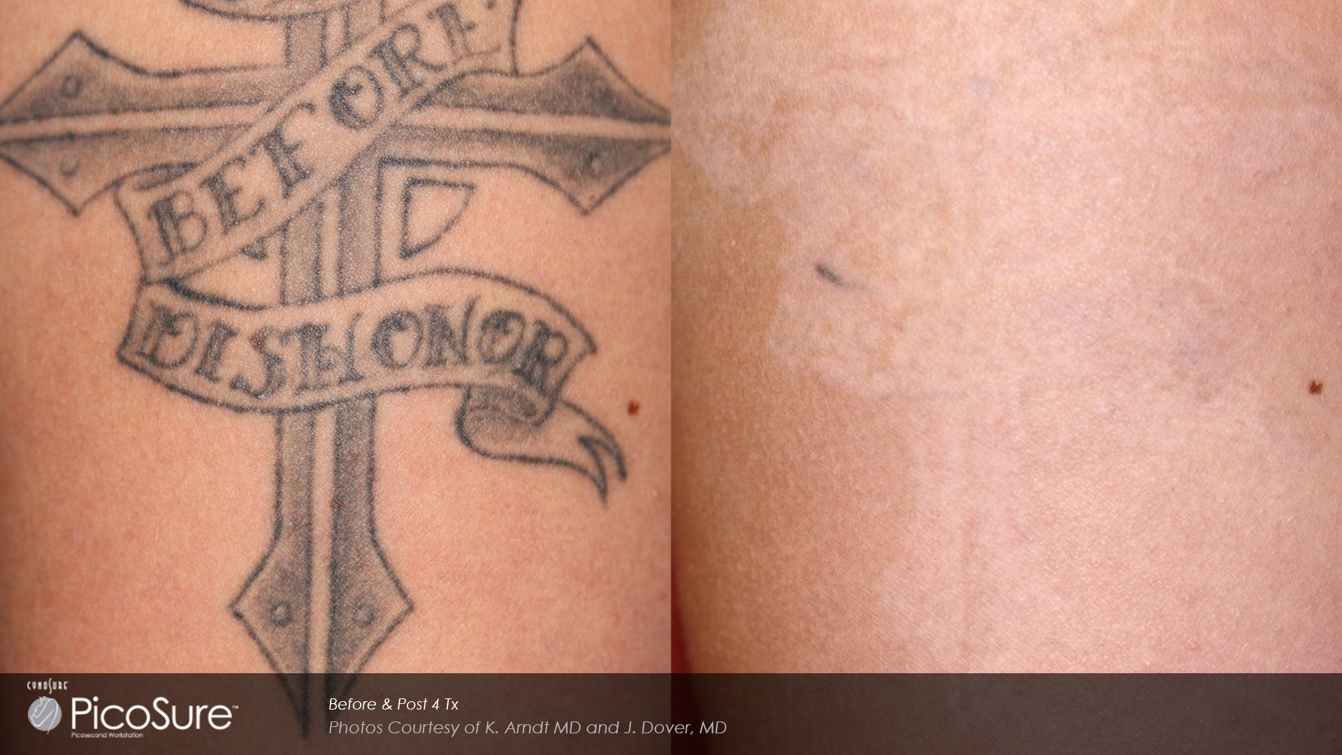 before and after PicoSure tattoo removal photos.
