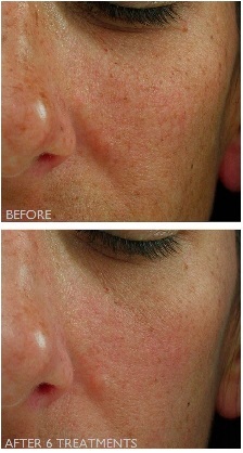 Before and after Clear + Brilliant treatments