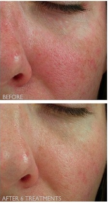 Before and after Clear + Brilliant treatments