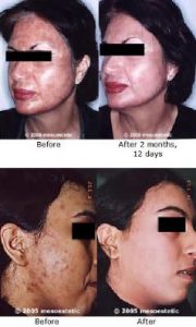 Before and after depigmentation treatments