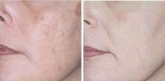 Before and after depigmentation treatments