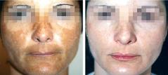 Before and after depigmentation treatments