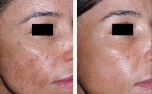 Melasma