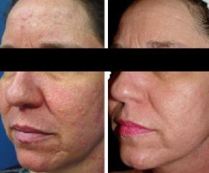 Skin Texture Before and After