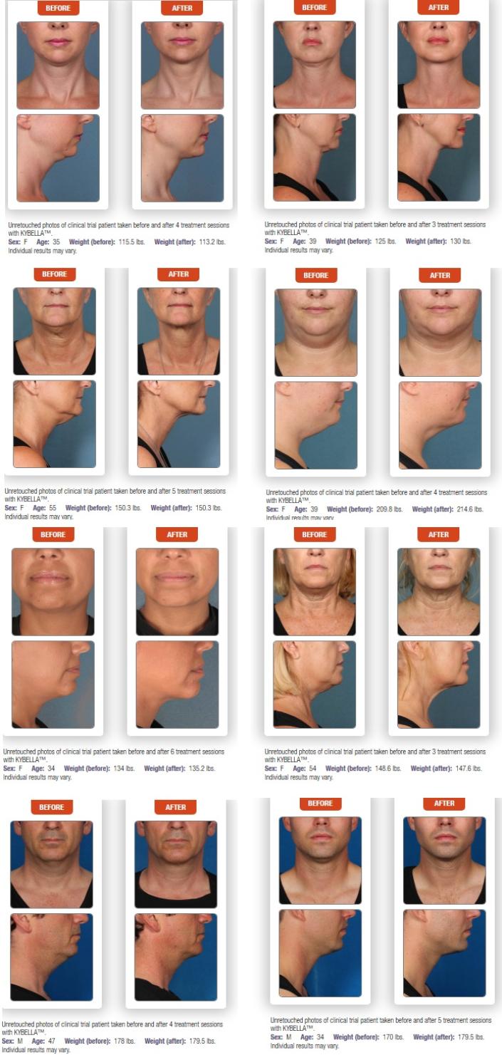 Before and after Kybella photos