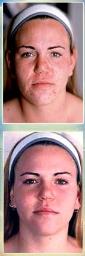 Before and after microdermabrasion treatments