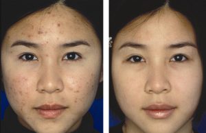 Before and after acne scarring treatments