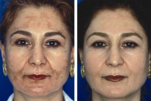 Before and after melasma and pigmenation treatments