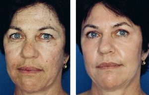 Before and after rejuvenation treatments