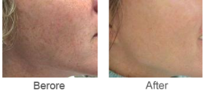 Before and after IPL treatments
