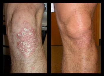 Before and after treatments