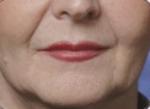 Before Restylane treatments