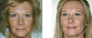 Before and after Sculptra photos