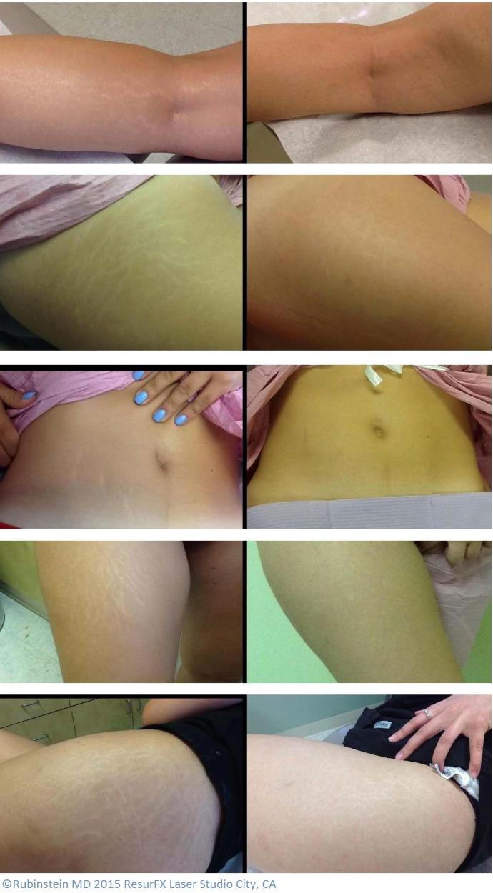 Before and after photos for stretch mark reduction